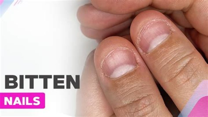 Revealed: Why people bite their nails