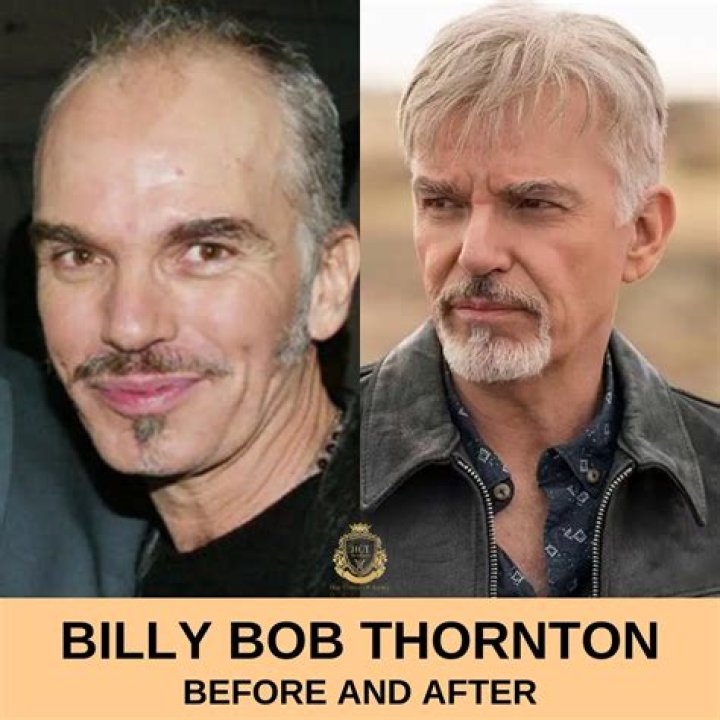 The Truth Behind Billy Bob Thornton's Scars Revealed